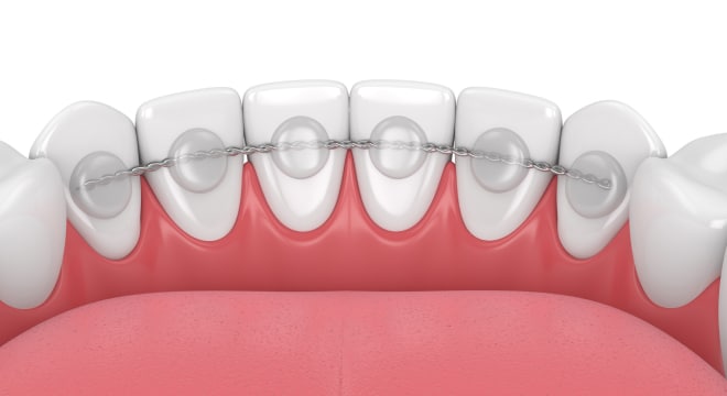 Graphic illustration of fixed retainer attached to back of lower teeth.