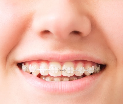 A close-up of a person's smile with braces on their teeth. Only the mouth and part of the nose are visible in the image.