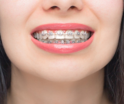 A close-up of a person smiling, showing teeth with braces and red lipstick. No recognizable landmarks or historical buildings are visible.