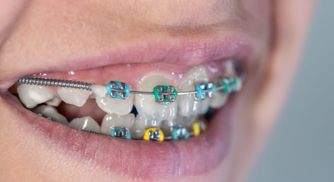 Close up of braces with a partial.