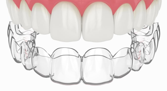 Clear aligner retainer