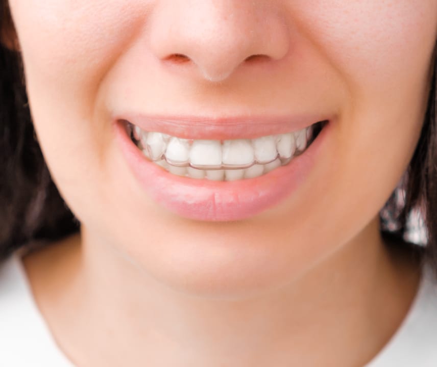 A person with an open-mouthed smile, showing teeth with clear aligners. The background is not visible, focusing solely on the lower part of the face.